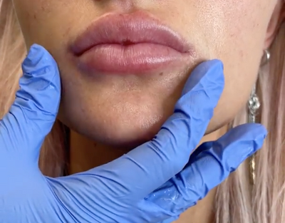 What’s the Difference Between Lip Filler and Lip Flip?