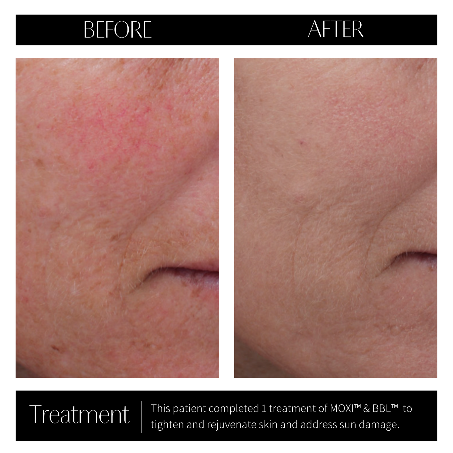 MOXI™ & BBL™ Skin Renewal Mint & Needle